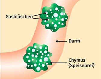 Vor der Einnahme von Espumisan® Emulsion: Zähe Schaumbläschen schließen das Gas ein und es kann nicht entweichen.