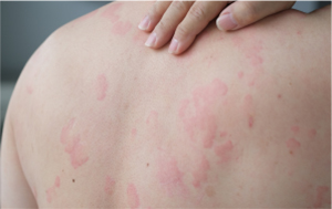 Haut mit Nesselsucht