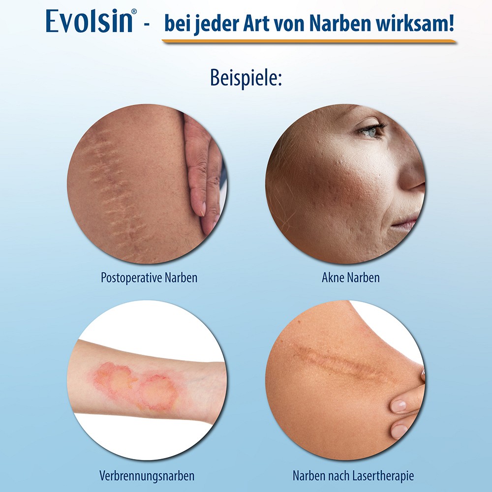 EVOLSIN Narbenpflaster 2x200 cm EVOLSIN Narbenpflaster 2x200 cm